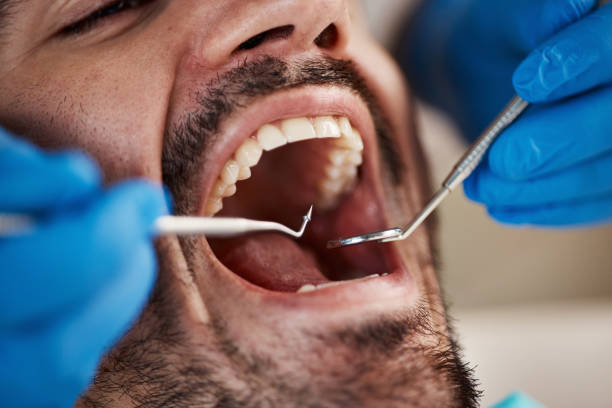 Best Emergency Dentist for Knocked-Out Tooth in Worthgton, IN